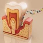 آندو دندان یا درمان ریشه دندان چیست؟